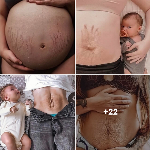 The Beauty of Imperfection: Celebrating a Mother’s Postpartum Stretch Marks.